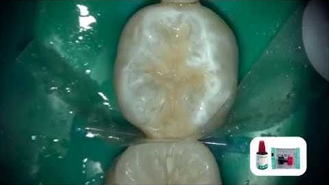 Class II Stress Bearing Restoration with EQUIA Forte