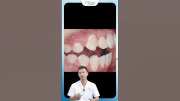 Niềng Răng Mắc Cài Mặt Lưỡi | Bác Sĩ Yên