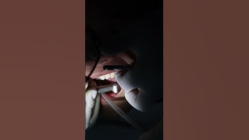 Tháo mắc cài sau hơn 16 tháng niềng răng #youtubeshorts #niengrang