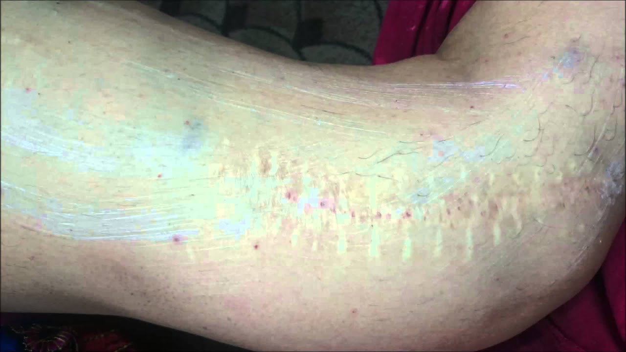 Acupuncture treatment effective for scar marks and stretch marks. YouTube