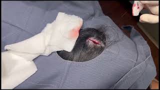 HEAD CYST EXTRACTION | YOU HAVE TO SEE THIS