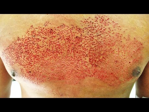 Question Hair plugs trypophobia agree, your Hair plugs trypophobia