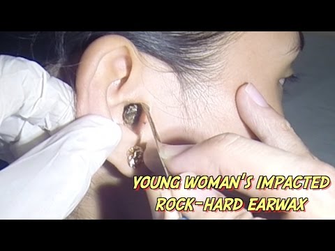 How do you remove hardened ear wax?