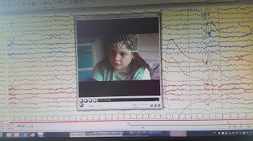 Seizure on video eeg 1