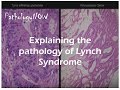 Explaining the pathology of Lynch Syndrome