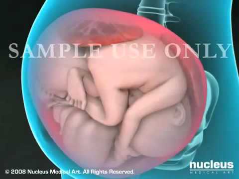 საკეისრო კვეთა