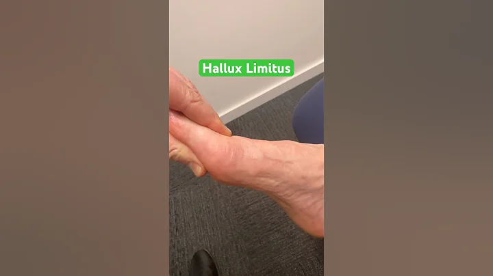Stiff big toe? Is it Hallux Limitus ?