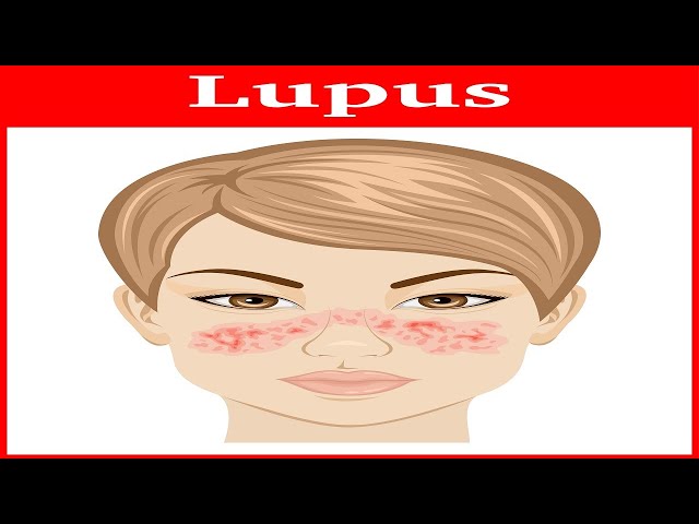 Lupus Rash: Plaquenil & Cellcept Didn't Help Her