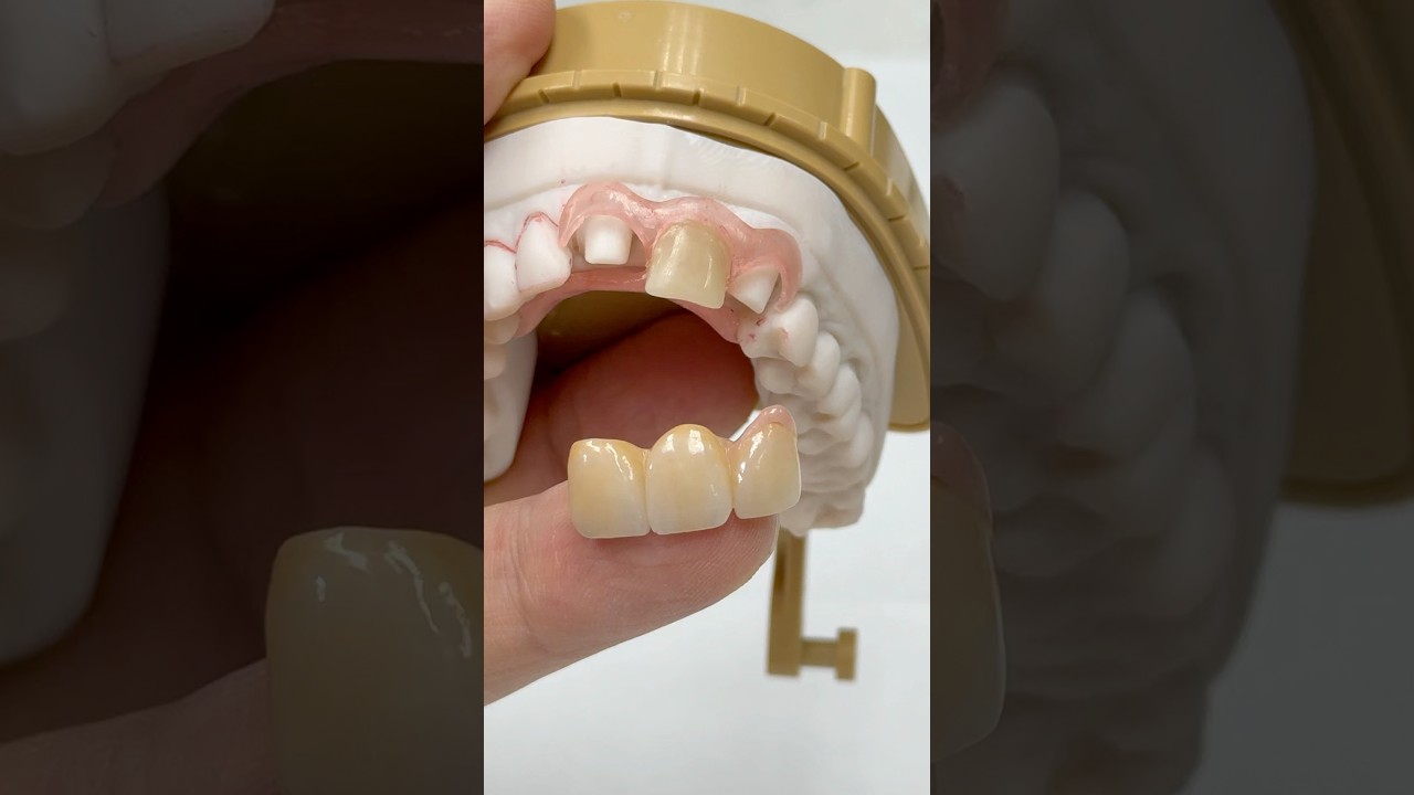 From a Nesbit to a Zirconia Bridge #lsk121shorts #dentist #teeth