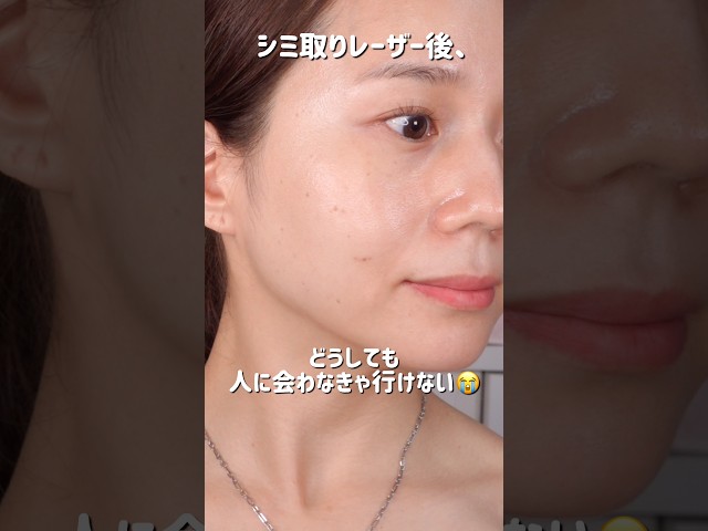 【プロが教える！】シミ取りレーザー後のダウンタイム中のカバーメイク術