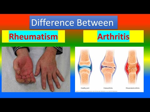 Difference between Rheumatism