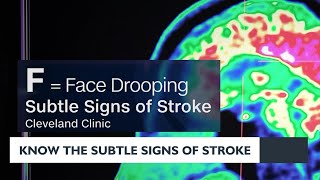 Know the subtle signs of a stroke