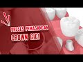 Pengen Tahu Pemasangan Crown Gigi? -  Dental Universe Indonesia