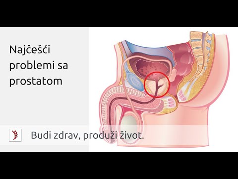 Video: Da li se tokom kolonoskopije provjerava prostata?