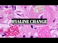 HYALINE CHANGE || FUNDAMENTALS WITH EXAMPLES ||