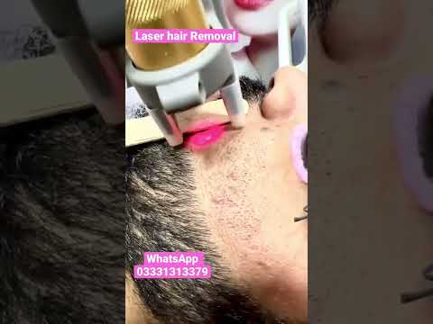 Laser hair remover