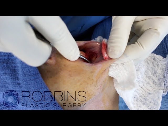 CHIN AUGMENTATION SURGERY- Award Winning " Best of Nashville" Plastic Surgeon Dr. Chad Robbins