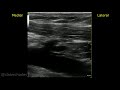 Ultrasound Guided Axillary Vein Access for Cardiac Implantable Devices