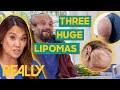 The largest lipoma removals of season 5  dr pimple popper