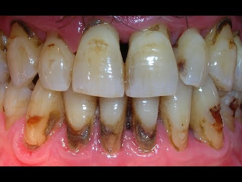 Video: Si t’i zbardhni dhëmbët: A mund të ndihmojnë mjetet juridike natyrore?