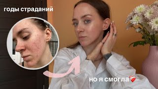 картинка: КАК я вылечила АКНЕ? Системные ретиноиды, акнекутан, эффезел