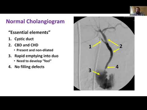 SAGES Laparoscopic Common Bile Duct Exploration: State of the Art - May 16, 2023