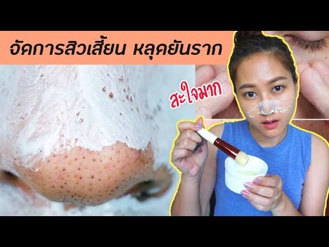 จัดการสิวเสี้ยน หลุดยันราก เพียงใช้ของที่หาได้จากในครัว l สรรหามาทำ