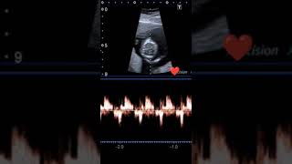 Fetal Heartbeat❤during pregnancy#shorts #fetaldevelopment#viral