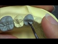 Live wax up - Lower 1st premolar (occlusion)