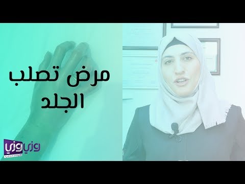 فيديو: تصلب الجلد: الأعراض والعلاج والتشخيص