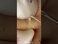 blackhead removal from nose/ old aged blackheads removal