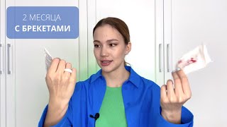 видео: 2 МЕСЯЦА С БРЕКЕТАМИ 🦷 | ФОТО | ИЗМЕНЕНИЯ картинка: 2 МЕСЯЦА С БРЕКЕТАМИ 🦷 | ФОТО | ИЗМЕНЕНИЯ