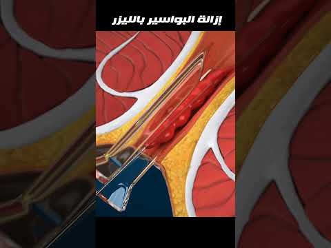 إزالة البواسير بالليزر