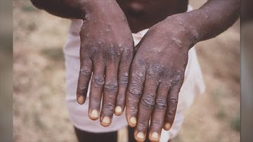 CDC alert: Monkeypox could look like a more common infection