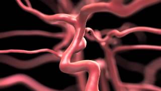 Aneurysm: Signs Symptoms Risks and Treatments Explained By Memorial Neuroscience Institute Resimi