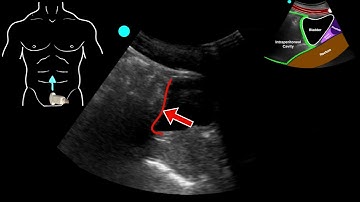 POCUS - Fall from ladder with lung point and pneumothorax