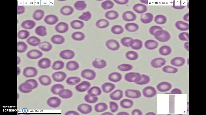 Tần số biến đổi glycosylation của p falciparum là gì năm 2024