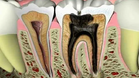 Endodontics - What Causes a Tooth Ache - DayDayNews