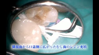 隣接面から口蓋側に広がったむし歯のレジン充填