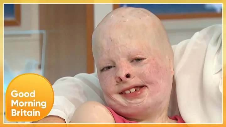 Brave Burn Victim Wins Pride Of Britain Award | Go...