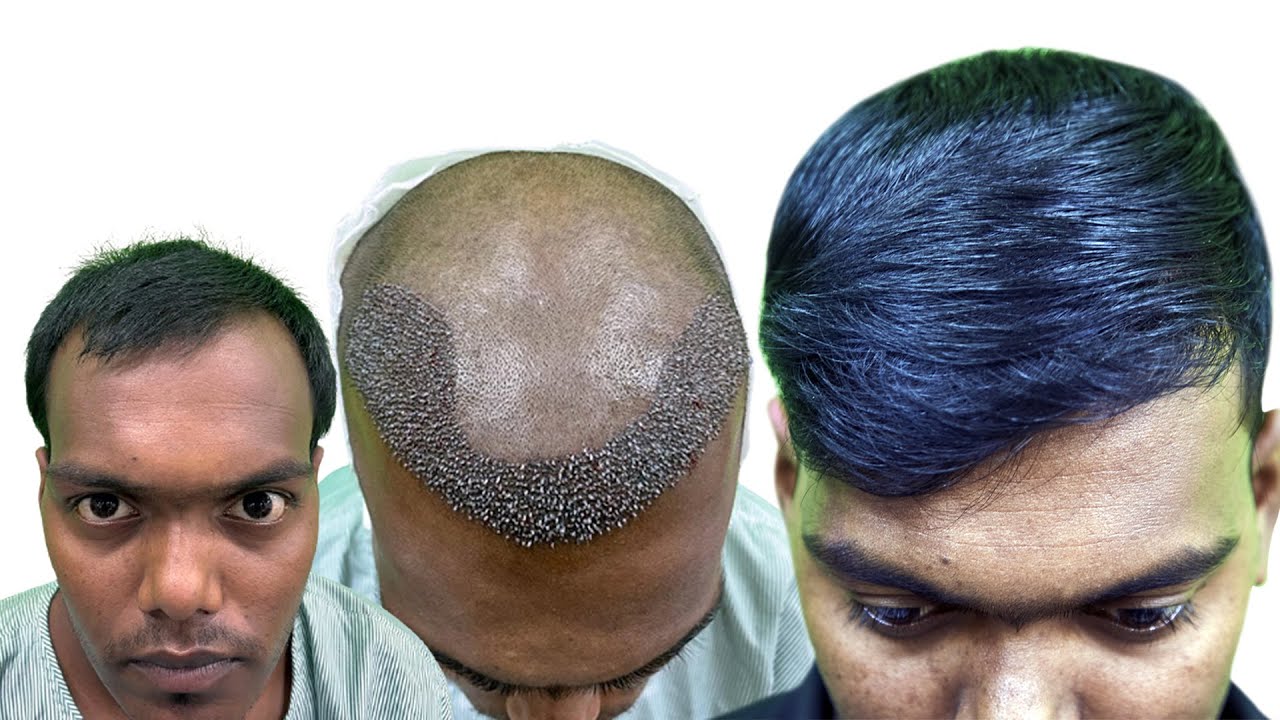 NATURAL Hair Transplant Result In KOLKATA kolkata 