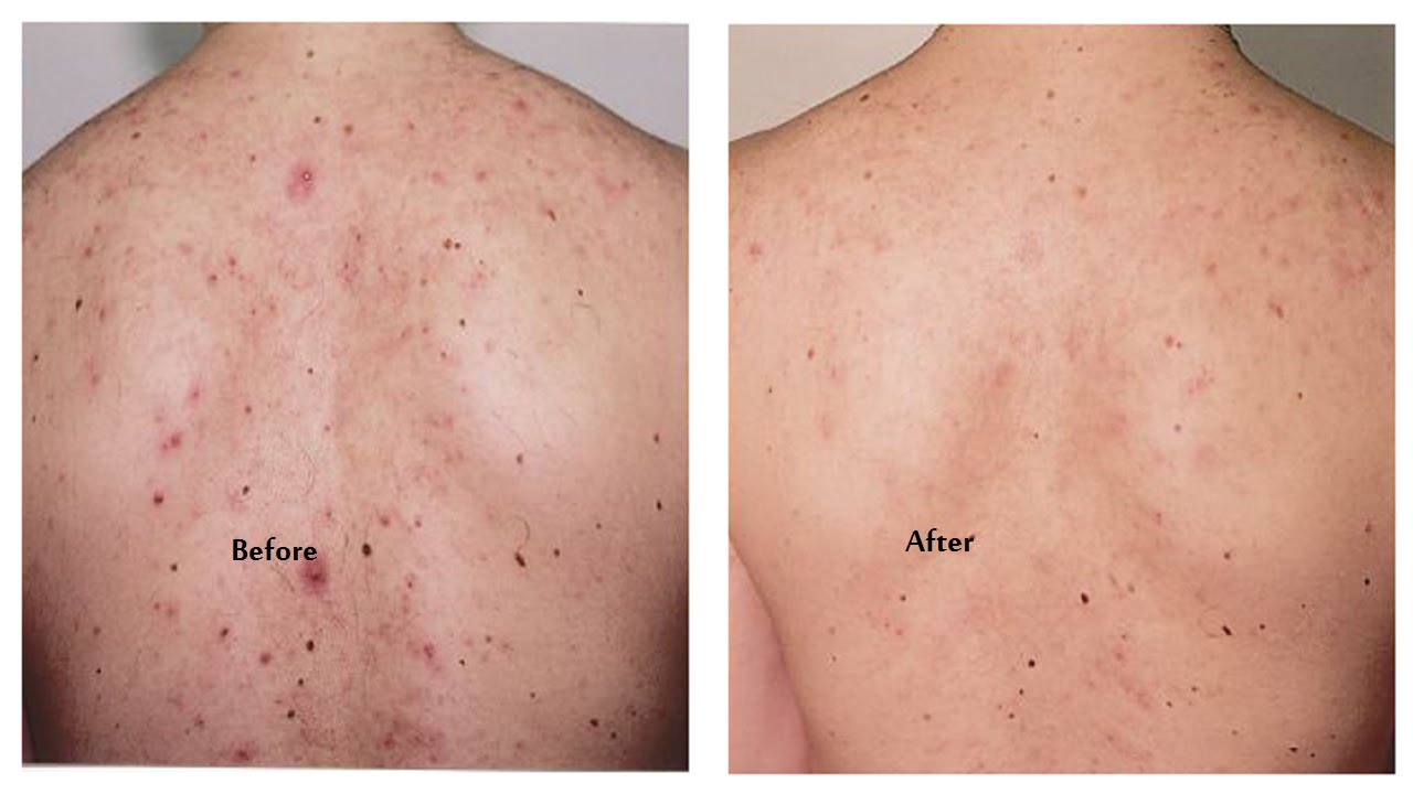 A Strong and Fast Treatment To Get Rid of Acne (For the Face & Body) - YouTube