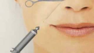 Τεχνική Fullfill Medical