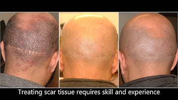 Hair Transplant Scar Repair with Vinci Hair Clinic - MSP