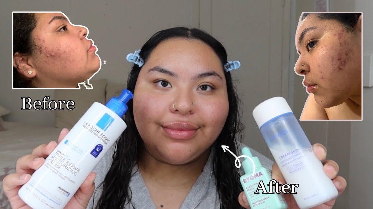 HOW I GOT RID OF MY ACNE/ MY SKINCARE NIGHT ROUTINE *PRODUCTS THATS ...