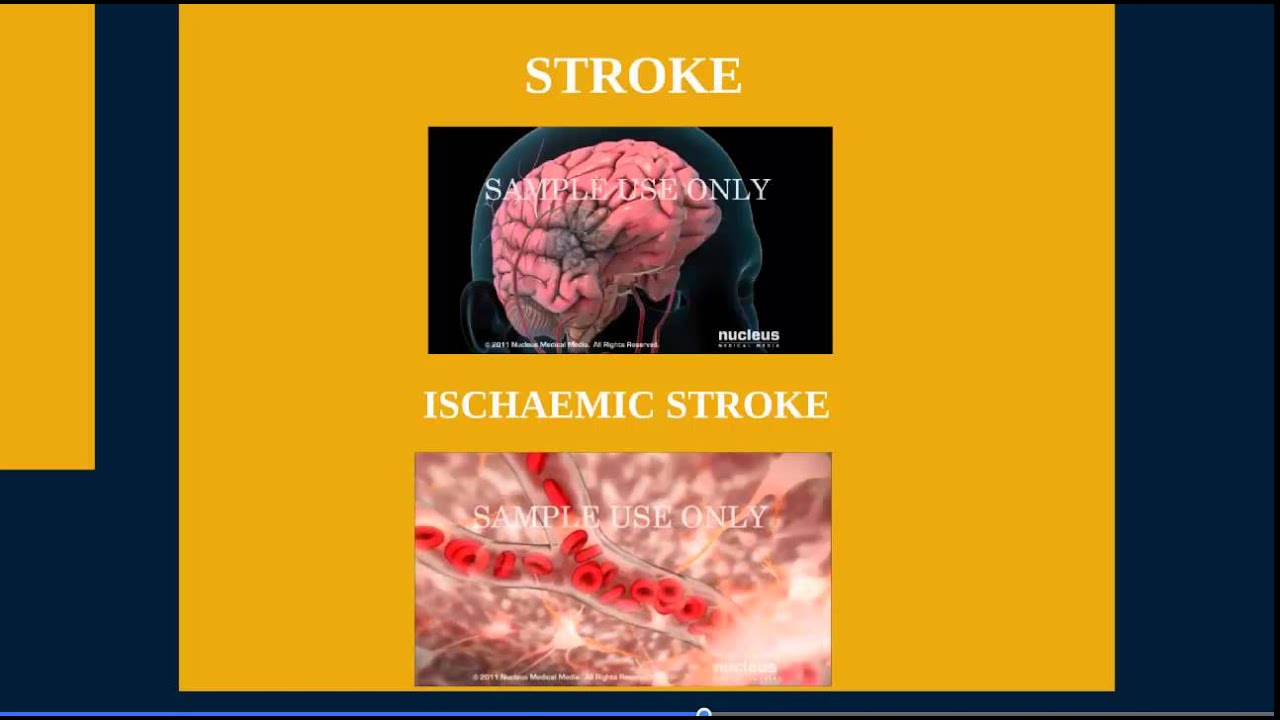 clopidrogel and aspirine in minor stroke YouTube