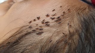 Head lice removal at home - How to find out a lot of head lice