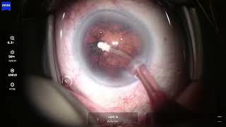 OD 2026 08 03 113028 Phaco