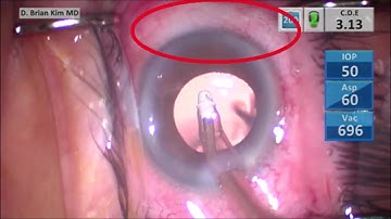 iStent inject W 1st case