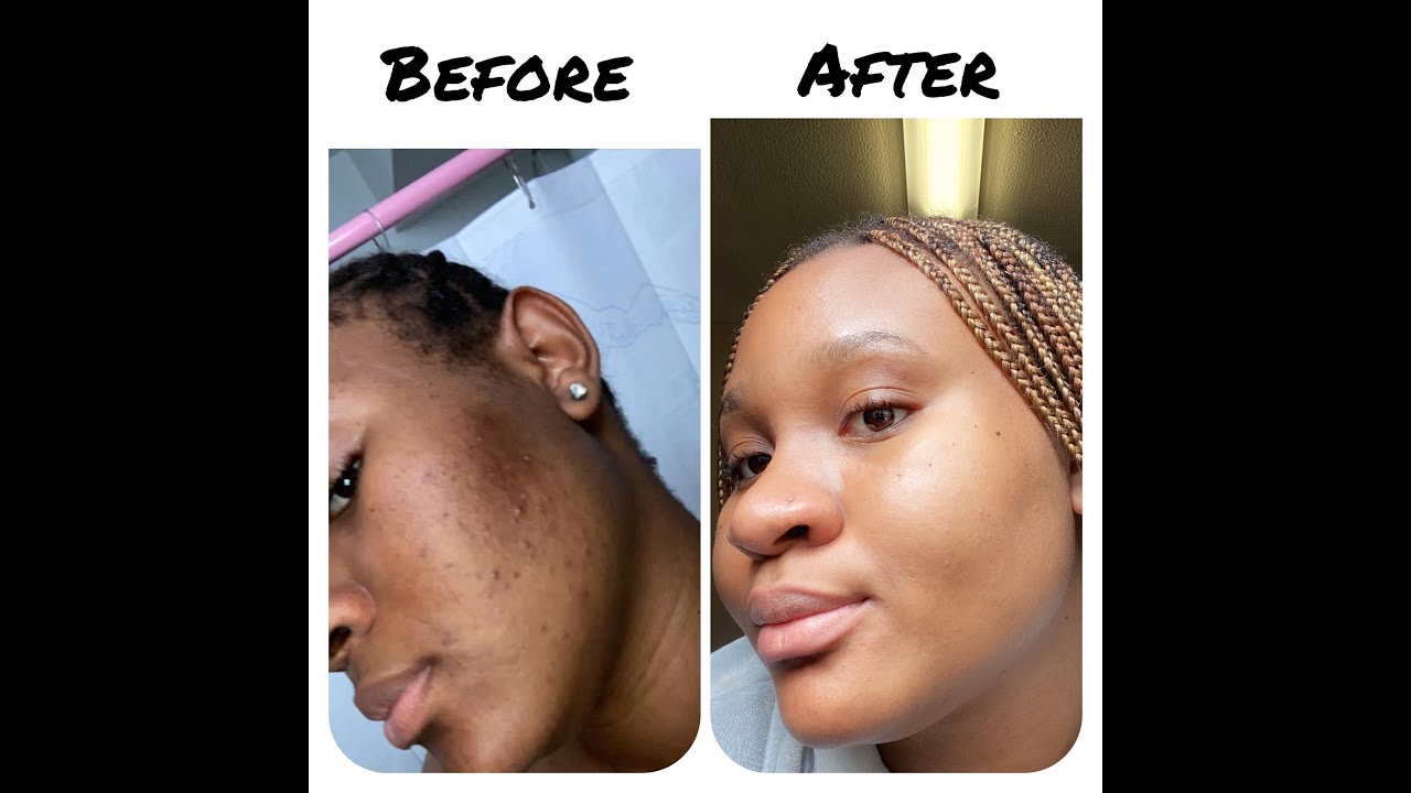 HOW TO GET CLEAR SKIN WITH AFFORDABLE PRODUCTS - YouTube